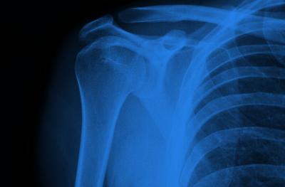 x-ray of collarbone